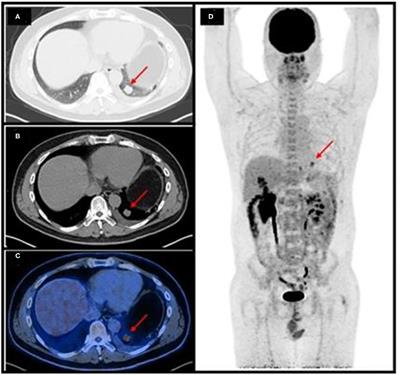 Case Report: 18F-FDG PET/CT Demonstrating Malignant Spread of a Pulmonary Epithelioid Hemangioendothelioma